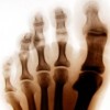 upload/articles/thumbs/170712035242Rheumatoid arthritis of the Foot.jpg